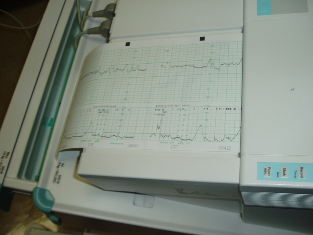 Graph of my heart beat and Mummy